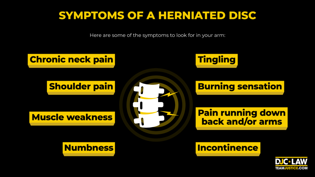  Illustration depicting the symptoms of a herniated disc, including pain, numbness, and weakness in the back and limbs.